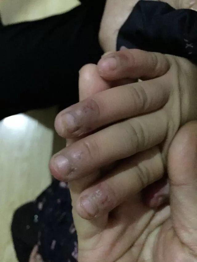 Bé gái 6 tuổi bị mẹ đẻ ngược đãi dã man khiến mặt đầy vết thương, tóc rụng thành mảng lớn